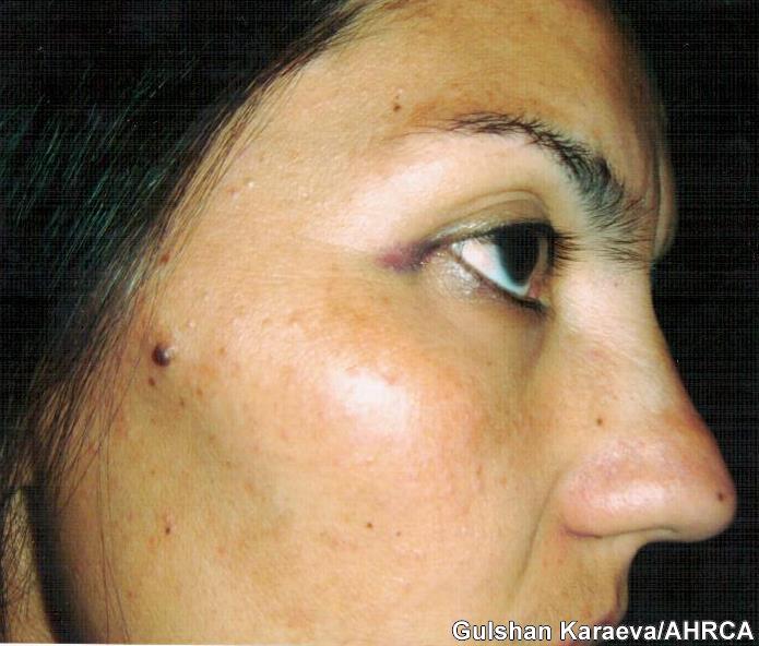 gematoma2 site